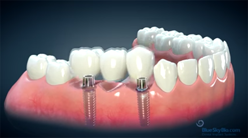 What is an implant?