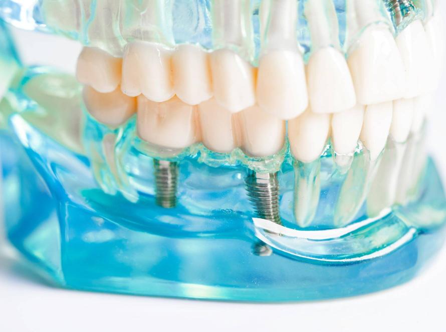 dental-implant-artificial-tooth-roots-into-jaw (1)