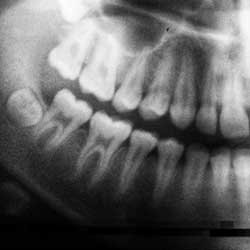 Wisdom Teeth Removal