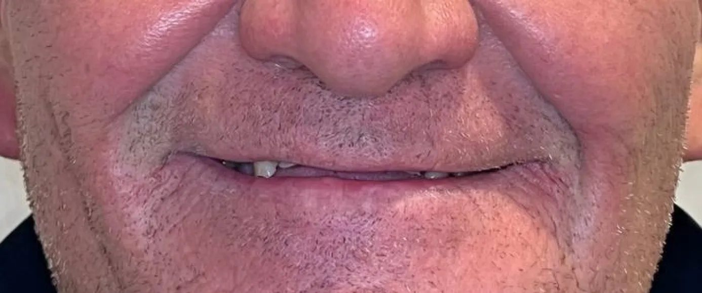 Before view of dental treatment by Dr. Desmond Ng