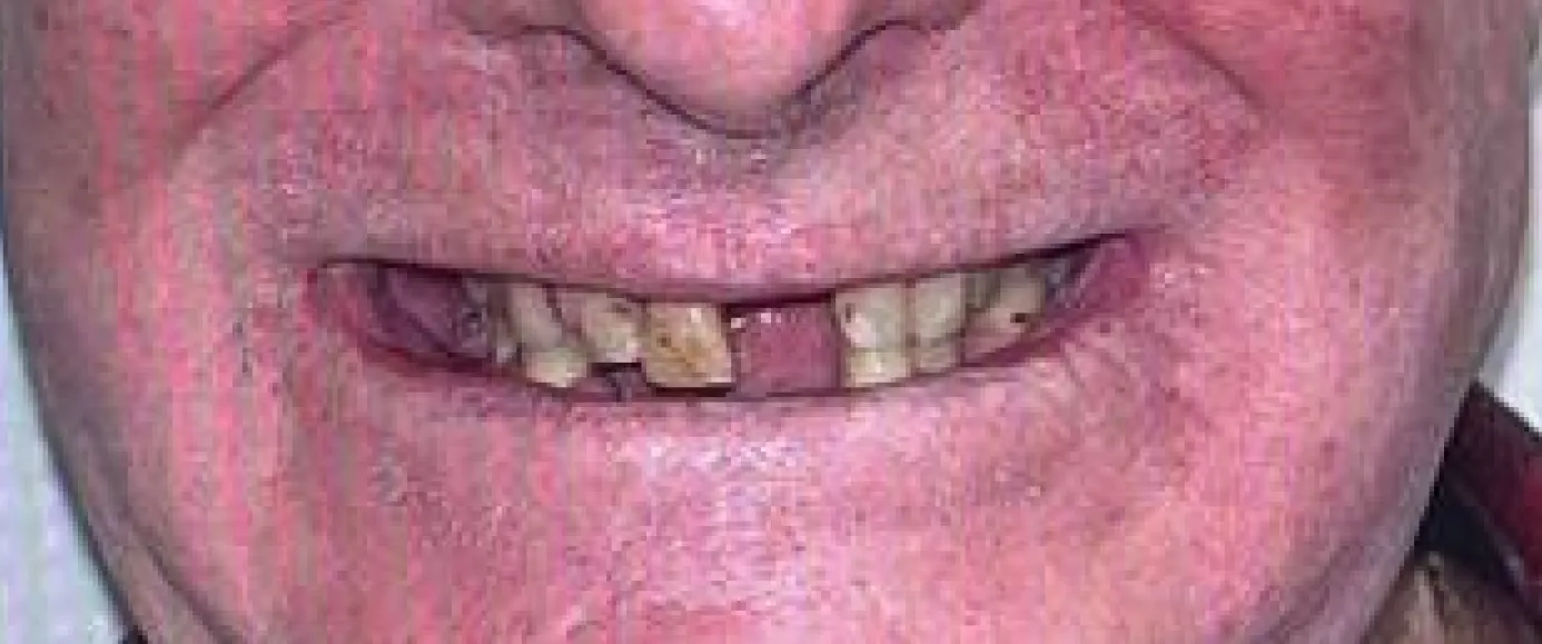 Before view of dental treatment by Dr. Desmond Ng