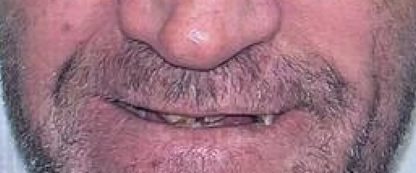 Before view of dental treatment by Dr. Desmond Ng