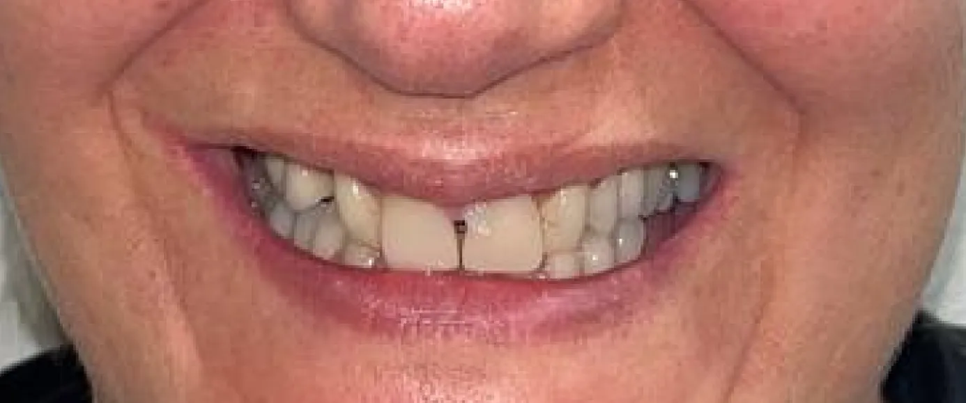 Before view of dental treatment by Dr. Desmond Ng