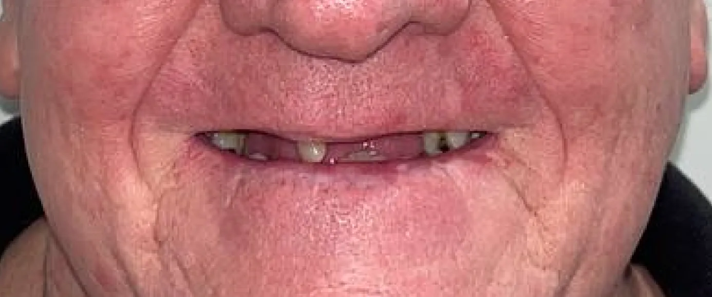 Before view of dental treatment by Dr. Desmond Ng