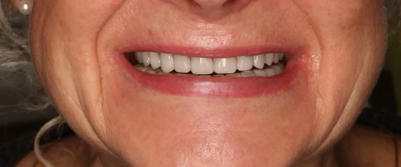 After view of dental treatment by Dr. Desmond Ng