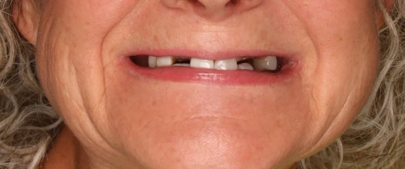 Before view of dental treatment by Dr. Desmond Ng