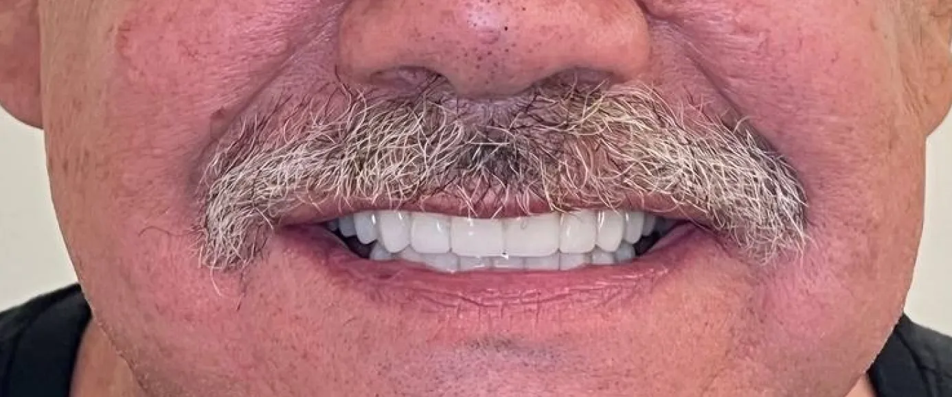 After view of dental treatment by Dr. Desmond Ng
