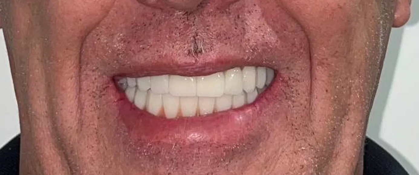 After view of dental treatment by Dr. Desmond Ng