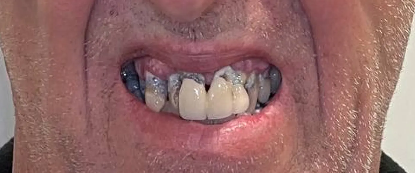 Before view of dental treatment by Dr. Desmond Ng