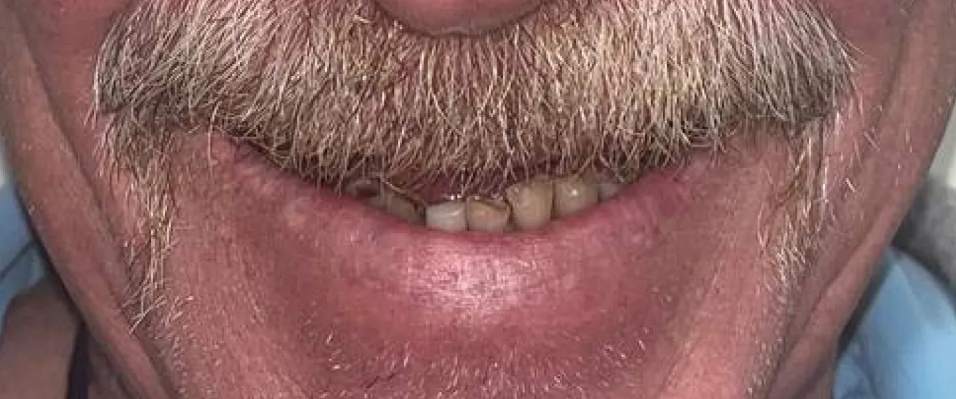 Before view of dental treatment by Dr. Desmond Ng