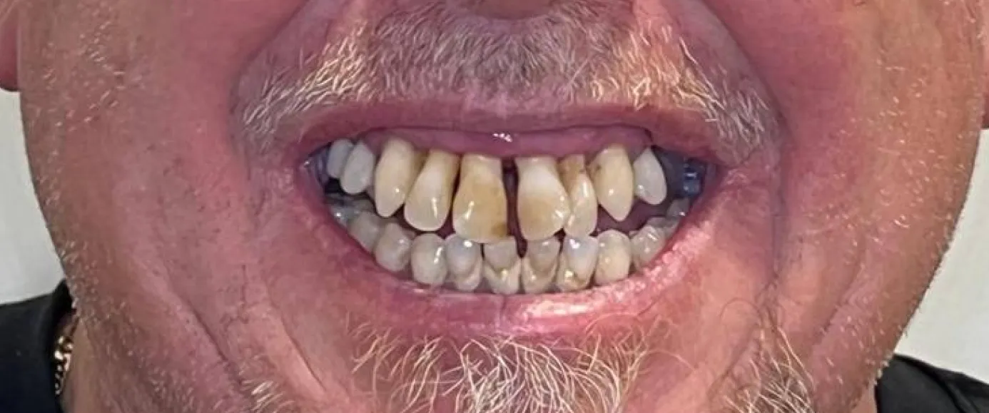 Before view of dental treatment by Dr. Desmond Ng