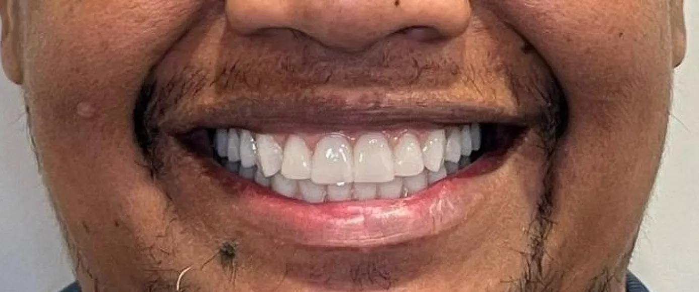 After view of dental treatment by Dr. Desmond Ng
