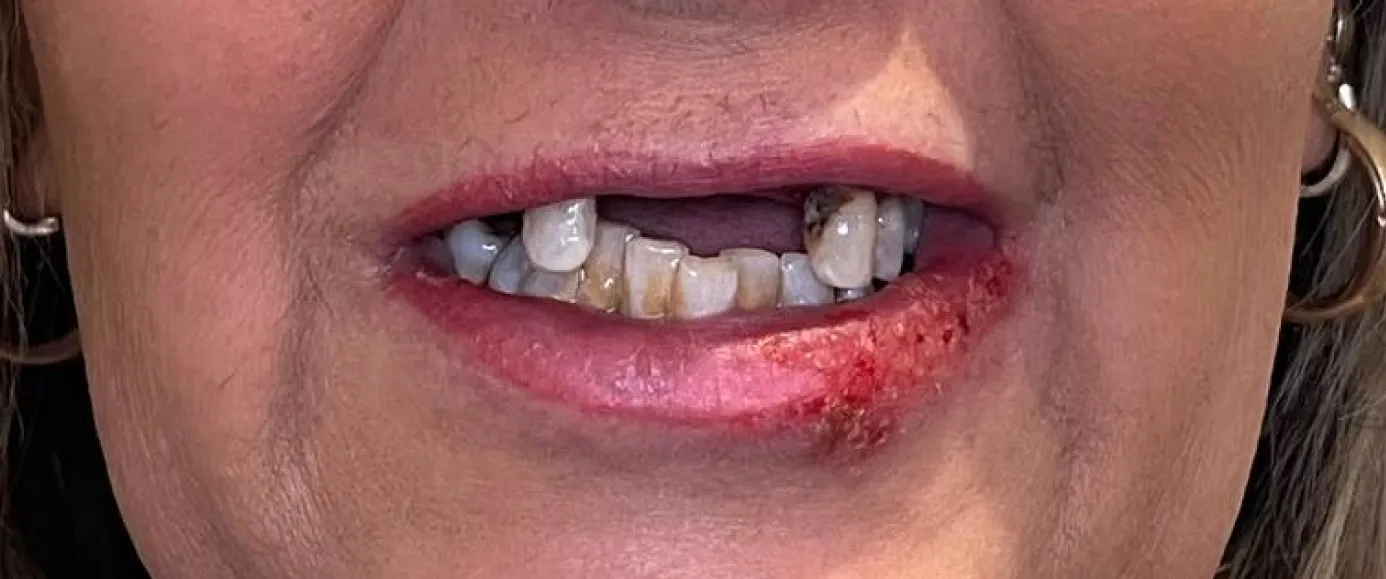 Before view of dental treatment by Dr. Desmond Ng