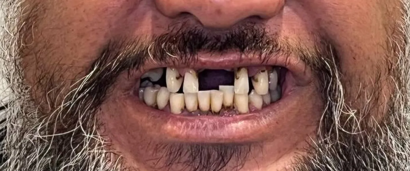 Before view of dental treatment by Dr. Desmond Ng